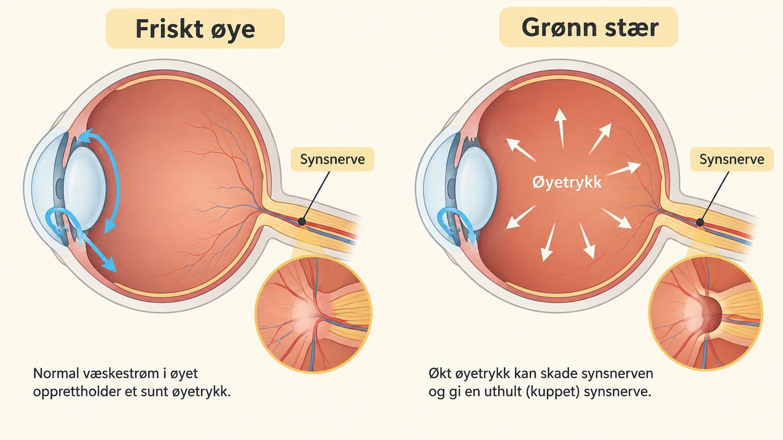 Tverrsnitt av et friskt øye og et øye med grønn stær, der økt øyetrykk skader synsnerven